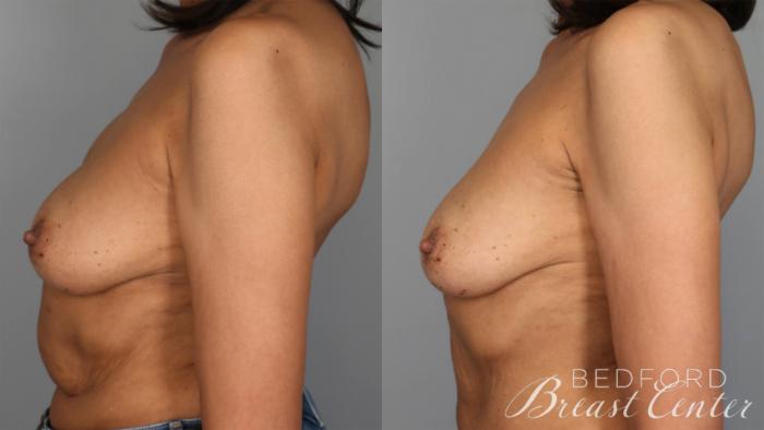 Before & After Nipple Sparing Mastectomy with One-Stage Breast Reconstruction Case 28 Left Side View in Beverly Hills, Los Angeles, Santa Monica, Glendale, and Malibu, CA