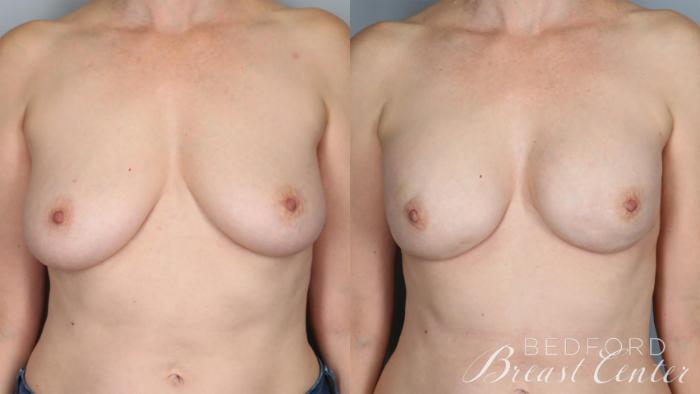 Before & After Nipple Sparing Mastectomy with One-Stage Breast Reconstruction Case 29 Front View in Beverly Hills, Los Angeles, Santa Monica, Glendale, and Malibu, CA