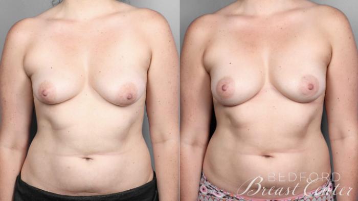 Before & After Nipple Sparing Mastectomy with One-Stage Breast Reconstruction Case 3 Front View in Beverly Hills, Los Angeles, Santa Monica, Glendale, and Malibu, CA