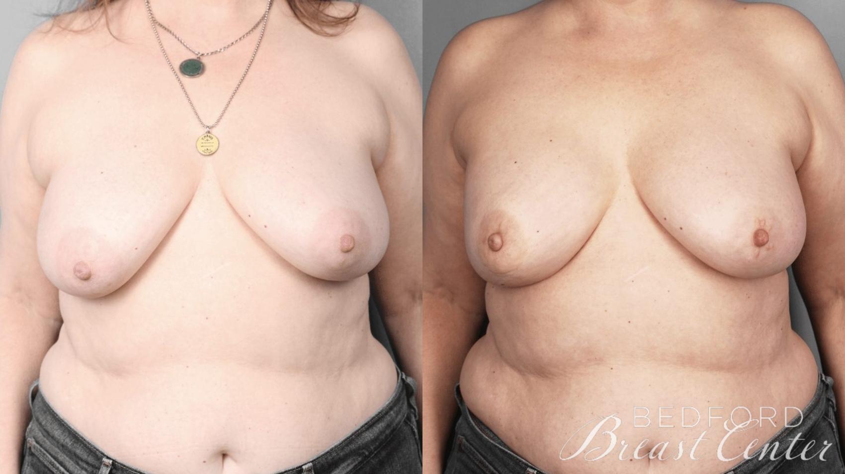 Before & After Nipple Sparing Mastectomy with One-Stage Breast Reconstruction Case 4 Front View in Beverly Hills, Los Angeles, Santa Monica, Glendale, and Malibu, CA