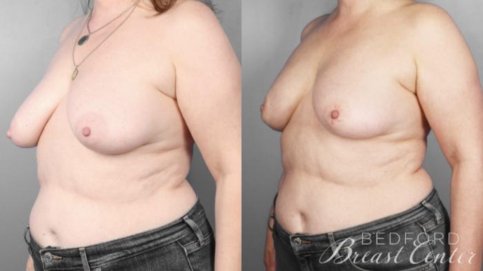 Before & After Nipple Sparing Mastectomy with One-Stage Breast Reconstruction Case 4 Left Oblique View in Beverly Hills, Los Angeles, Santa Monica, Glendale, and Malibu, CA