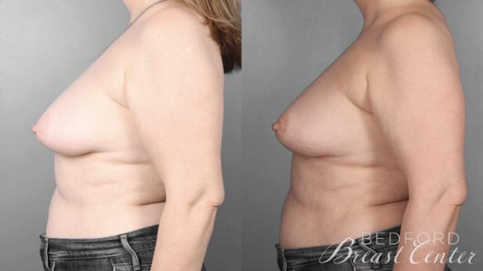 Before & After Nipple Sparing Mastectomy with One-Stage Breast Reconstruction Case 4 Left Side View in Beverly Hills, Los Angeles, Santa Monica, Glendale, and Malibu, CA