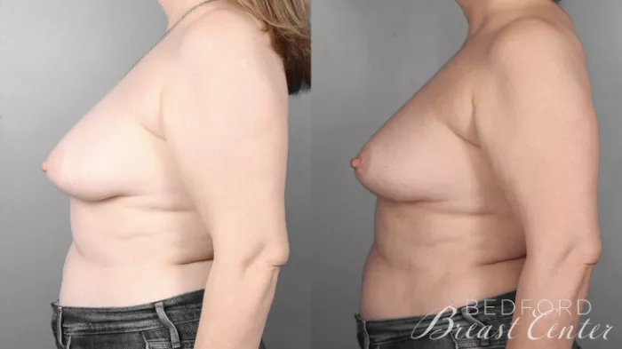 Nipple Sparing Mastectomy with One-Stage Breast Reconstruction Before and  After Pictures Case 4 – Beverly Hills, Los Angeles, Santa Monica, Glendale,  and Malibu, CA – Bedford Breast Center