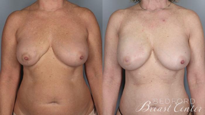 Before & After Nipple Sparing Mastectomy with One-Stage Breast Reconstruction Case 5 Front View in Beverly Hills, Los Angeles, Santa Monica, Glendale, and Malibu, CA