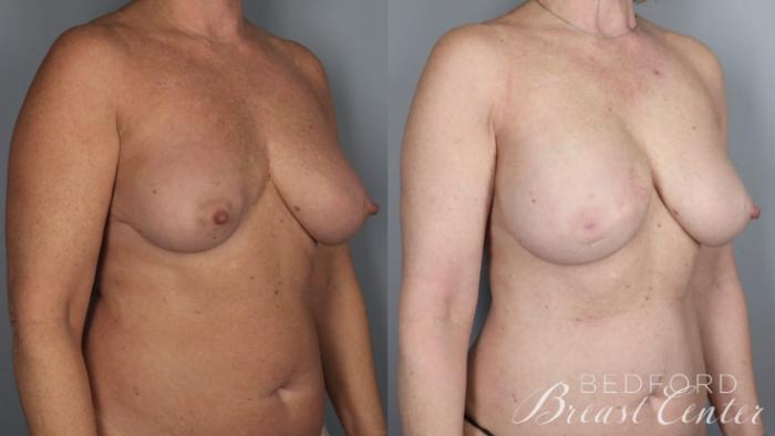 Before & After Nipple Sparing Mastectomy with One-Stage Breast Reconstruction Case 5 Right Oblique View in Beverly Hills, Los Angeles, Santa Monica, Glendale, and Malibu, CA