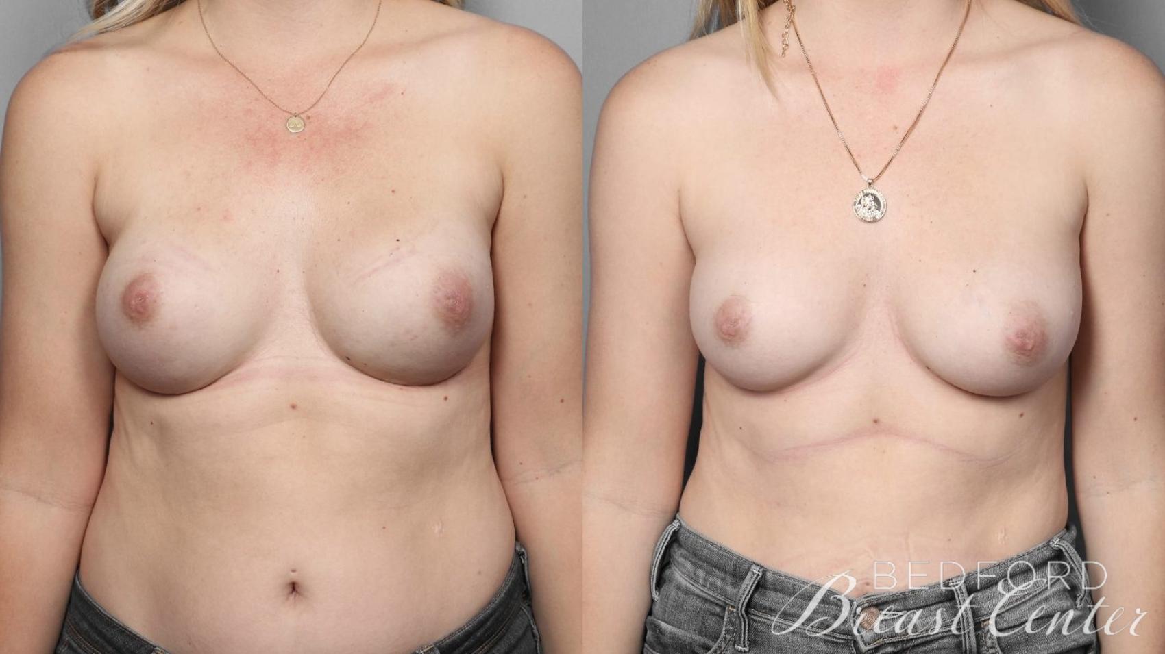 Before & After Nipple Sparing Mastectomy with One-Stage Breast Reconstruction Case 6 Front View in Beverly Hills, Los Angeles, Santa Monica, Glendale, and Malibu, CA