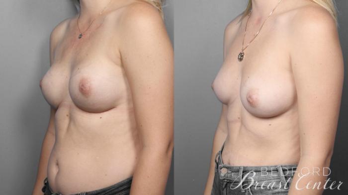 Before & After Nipple Sparing Mastectomy with One-Stage Breast Reconstruction Case 6 Left Oblique View in Beverly Hills, Los Angeles, Santa Monica, Glendale, and Malibu, CA