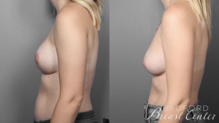 Before & After Nipple Sparing Mastectomy with One-Stage Breast Reconstruction Case 6 Left Side View in Beverly Hills, Los Angeles, Santa Monica, Glendale, and Malibu, CA