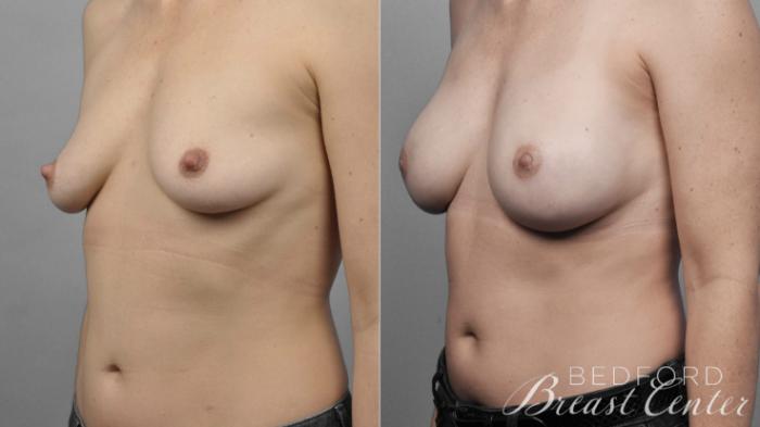 Before & After Nipple Sparing Mastectomy with One-Stage Breast Reconstruction Case 8 Left Oblique View in Beverly Hills, Los Angeles, Santa Monica, Glendale, and Malibu, CA