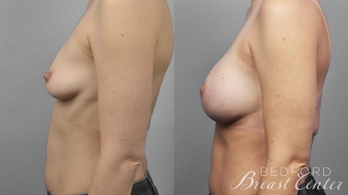 Before & After Nipple Sparing Mastectomy with One-Stage Breast Reconstruction Case 8 Left Side View in Beverly Hills, Los Angeles, Santa Monica, Glendale, and Malibu, CA