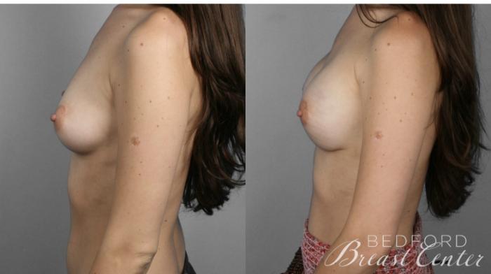 Before & After Nipple Sparing Mastectomy with One-Stage Breast Reconstruction Case 9 Left Side View in Beverly Hills, Los Angeles, Santa Monica, Glendale, and Malibu, CA