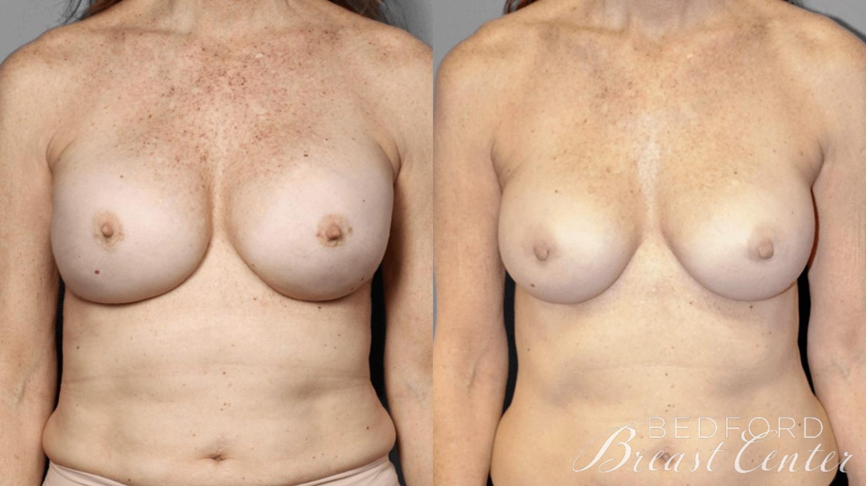 Before & After Nipple Sparing Mastectomy with One-Stage Breast Reconstruction Case 1 Front View in Beverly Hills, Los Angeles, Santa Monica, Glendale, and Malibu, CA