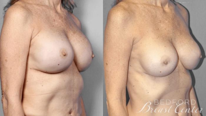 Before & After Nipple Sparing Mastectomy with One-Stage Breast Reconstruction Case 1 Right Oblique View in Beverly Hills, Los Angeles, Santa Monica, Glendale, and Malibu, CA