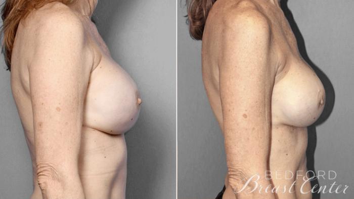 Before & After Nipple Sparing Mastectomy with One-Stage Breast Reconstruction Case 1 Right Side View in Beverly Hills, Los Angeles, Santa Monica, Glendale, and Malibu, CA