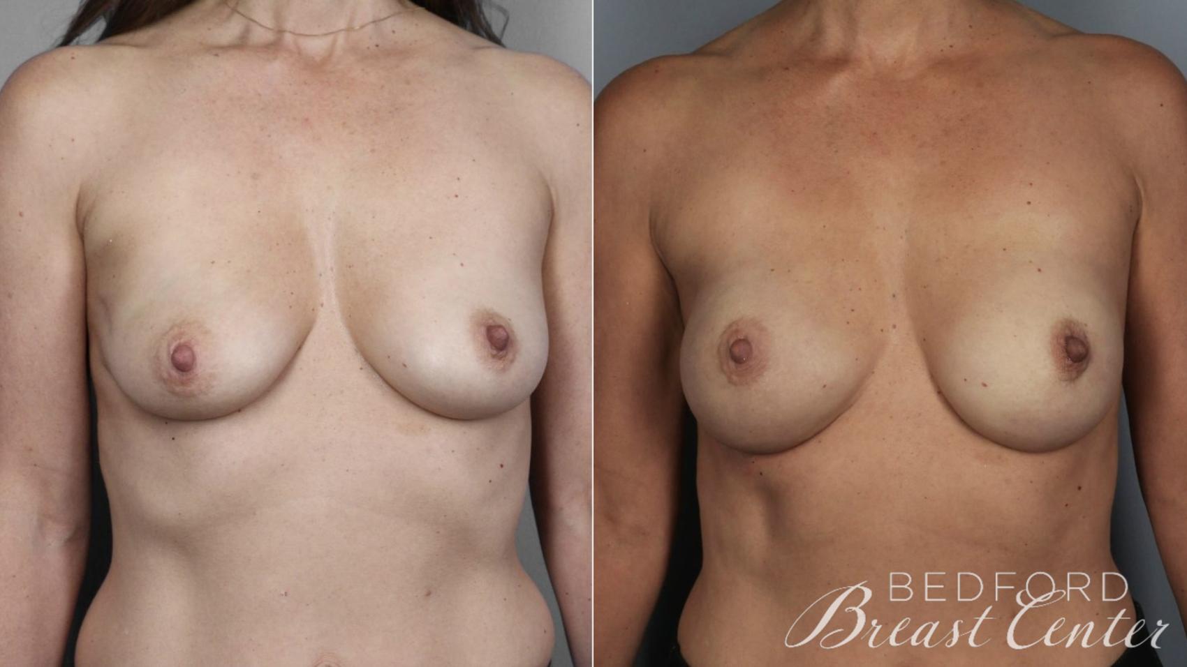 Before & After Nipple Sparing Mastectomy with One-Stage Breast Reconstruction Case 2 Front View in Beverly Hills, Los Angeles, Santa Monica, Glendale, and Malibu, CA