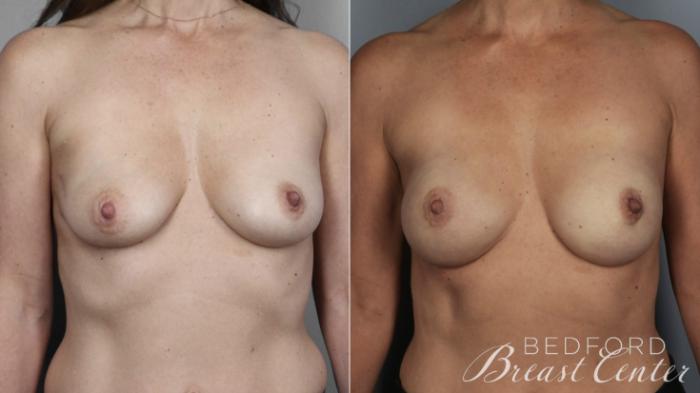 Before & After Nipple Sparing Mastectomy with One-Stage Breast Reconstruction Case 2 Front View in Beverly Hills, CA