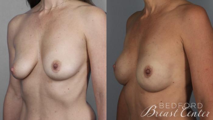 Before & After Nipple Sparing Mastectomy with One-Stage Breast Reconstruction Case 2 Left Oblique View in Beverly Hills, Los Angeles, Santa Monica, Glendale, and Malibu, CA