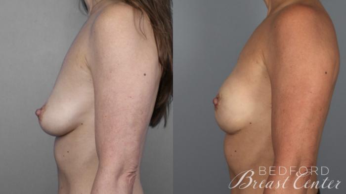 Before & After Nipple Sparing Mastectomy with One-Stage Breast Reconstruction Case 2 Left Side View in Beverly Hills, Los Angeles, Santa Monica, Glendale, and Malibu, CA