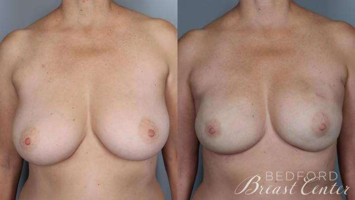 Before & After Nipple Sparing Mastectomy with One-Stage Breast Reconstruction Case 26 Front View in Beverly Hills, CA