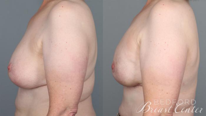 Before & After Nipple Sparing Mastectomy with One-Stage Breast Reconstruction Case 27 Left Side View in Beverly Hills, CA