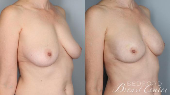 Before & After Nipple Sparing Mastectomy with One-Stage Breast Reconstruction Case 29 Right Oblique View in Beverly Hills, Los Angeles, Santa Monica, Glendale, and Malibu, CA