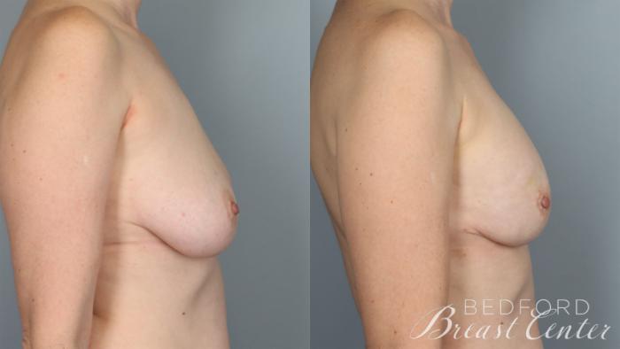 Before & After Nipple Sparing Mastectomy with One-Stage Breast Reconstruction Case 29 Right Side View in Beverly Hills, Los Angeles, Santa Monica, Glendale, and Malibu, CA