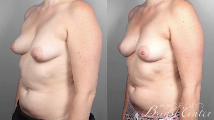 Before & After Nipple Sparing Mastectomy with One-Stage Breast Reconstruction Case 3 Left Oblique View in Beverly Hills, Los Angeles, Santa Monica, Glendale, and Malibu, CA