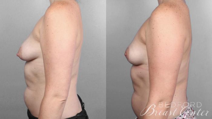Before & After Nipple Sparing Mastectomy with One-Stage Breast Reconstruction Case 3 Left Side View in Beverly Hills, Los Angeles, Santa Monica, Glendale, and Malibu, CA