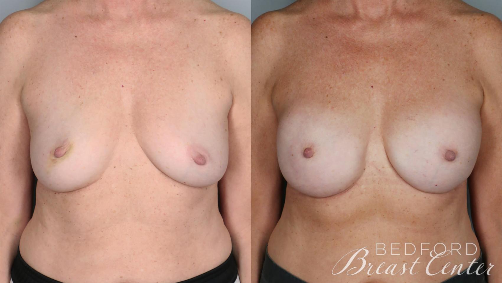 Before & After Nipple Sparing Mastectomy with One-Stage Breast Reconstruction Case 30 Front View in Beverly Hills, Los Angeles, Santa Monica, Glendale, and Malibu, CA
