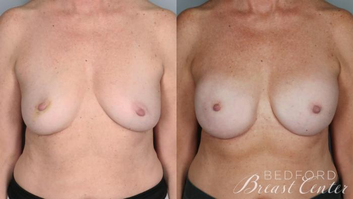 Before & After Nipple Sparing Mastectomy with One-Stage Breast Reconstruction Case 30 Front View in Beverly Hills, CA