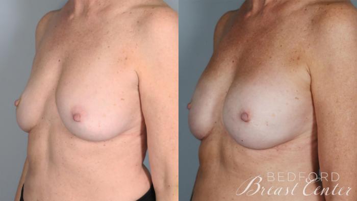 Before & After Nipple Sparing Mastectomy with One-Stage Breast Reconstruction Case 30 Left Oblique View in Beverly Hills, Los Angeles, Santa Monica, Glendale, and Malibu, CA