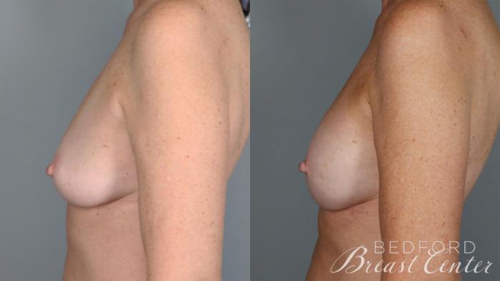 Before & After Nipple Sparing Mastectomy with One-Stage Breast Reconstruction Case 30 Left Side View in Beverly Hills, Los Angeles, Santa Monica, Glendale, and Malibu, CA