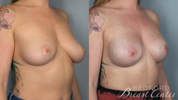 Before & After Nipple Sparing Mastectomy with One-Stage Breast Reconstruction Case 31 Right Oblique View in Beverly Hills, Los Angeles, Santa Monica, Glendale, and Malibu, CA