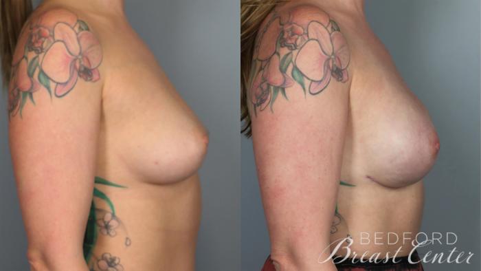 Before & After Nipple Sparing Mastectomy with One-Stage Breast Reconstruction Case 31 Right Side View in Beverly Hills, Los Angeles, Santa Monica, Glendale, and Malibu, CA
