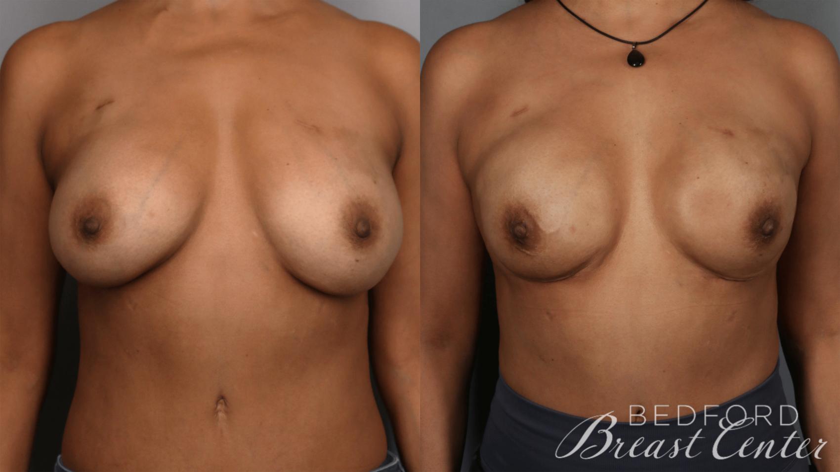 Before & After Nipple Sparing Mastectomy with One-Stage Breast Reconstruction Case 32 Front View in Beverly Hills, Los Angeles, Santa Monica, Glendale, and Malibu, CA