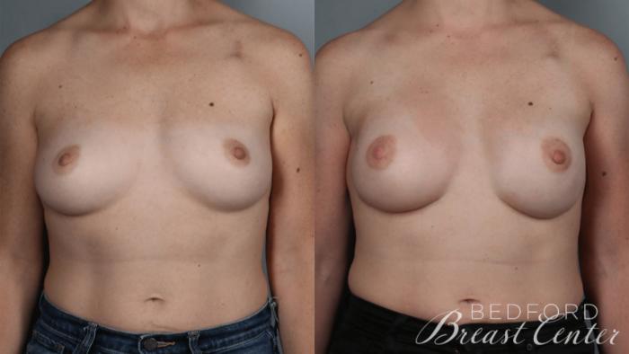 Before & After Nipple Sparing Mastectomy with One-Stage Breast Reconstruction Case 33 Front View in Beverly Hills, Los Angeles, Santa Monica, Glendale, and Malibu, CA