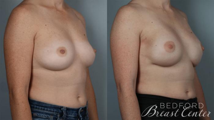 Before & After Nipple Sparing Mastectomy with One-Stage Breast Reconstruction Case 33 Left Oblique View in Beverly Hills, Los Angeles, Santa Monica, Glendale, and Malibu, CA