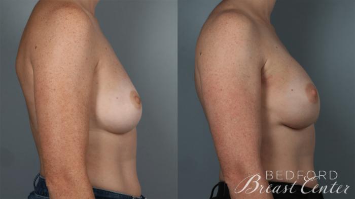 Before & After Nipple Sparing Mastectomy with One-Stage Breast Reconstruction Case 33 Left Side View in Beverly Hills, Los Angeles, Santa Monica, Glendale, and Malibu, CA