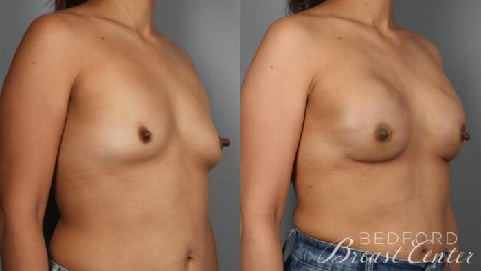 Before & After Nipple Sparing Mastectomy with One-Stage Breast Reconstruction Case 34 Left Oblique View in Beverly Hills, Los Angeles, Santa Monica, Glendale, and Malibu, CA