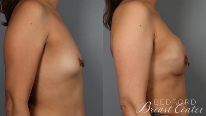 Before & After Nipple Sparing Mastectomy with One-Stage Breast Reconstruction Case 34 Left Side View in Beverly Hills, Los Angeles, Santa Monica, Glendale, and Malibu, CA