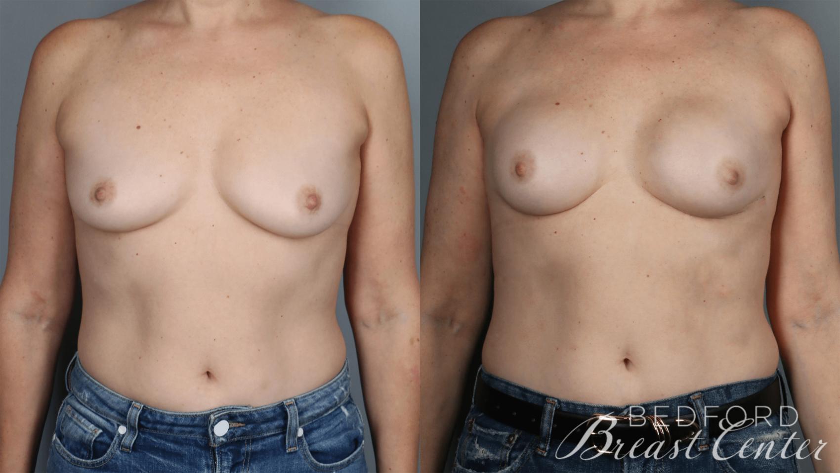 Before & After Nipple Sparing Mastectomy with One-Stage Breast Reconstruction Case 35 Front View in Beverly Hills, Los Angeles, Santa Monica, Glendale, and Malibu, CA