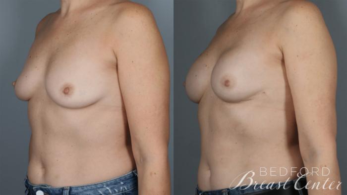 Before & After Nipple Sparing Mastectomy with One-Stage Breast Reconstruction Case 35 Right Oblique View in Beverly Hills, Los Angeles, Santa Monica, Glendale, and Malibu, CA