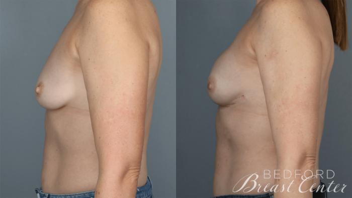 Before & After Nipple Sparing Mastectomy with One-Stage Breast Reconstruction Case 35 Right Side View in Beverly Hills, Los Angeles, Santa Monica, Glendale, and Malibu, CA