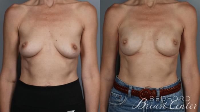 Before & After Nipple Sparing Mastectomy with One-Stage Breast Reconstruction Case 36 Front View in Beverly Hills, Los Angeles, Santa Monica, Glendale, and Malibu, CA