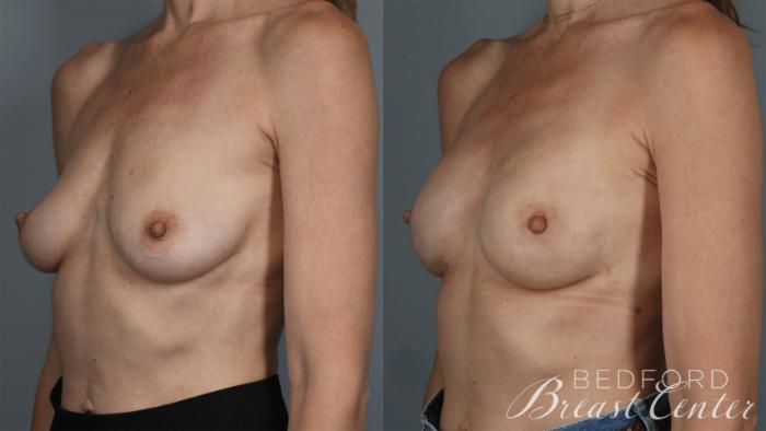 Before & After Nipple Sparing Mastectomy with One-Stage Breast Reconstruction Case 36 Left Oblique View in Beverly Hills, Los Angeles, Santa Monica, Glendale, and Malibu, CA