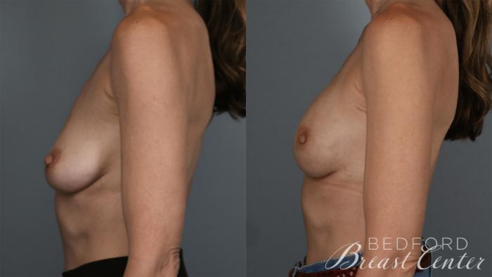 Before & After Nipple Sparing Mastectomy with One-Stage Breast Reconstruction Case 36 Left Side View in Beverly Hills, Los Angeles, Santa Monica, Glendale, and Malibu, CA