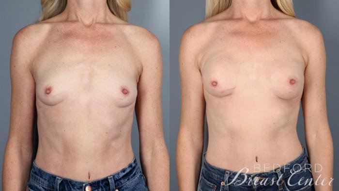 Before & After Nipple Sparing Mastectomy with One-Stage Breast Reconstruction Case 37 Front View in Beverly Hills, Los Angeles, Santa Monica, Glendale, and Malibu, CA