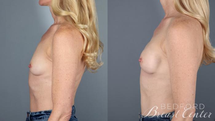 Before & After Nipple Sparing Mastectomy with One-Stage Breast Reconstruction Case 37 Left Side View in Beverly Hills, Los Angeles, Santa Monica, Glendale, and Malibu, CA
