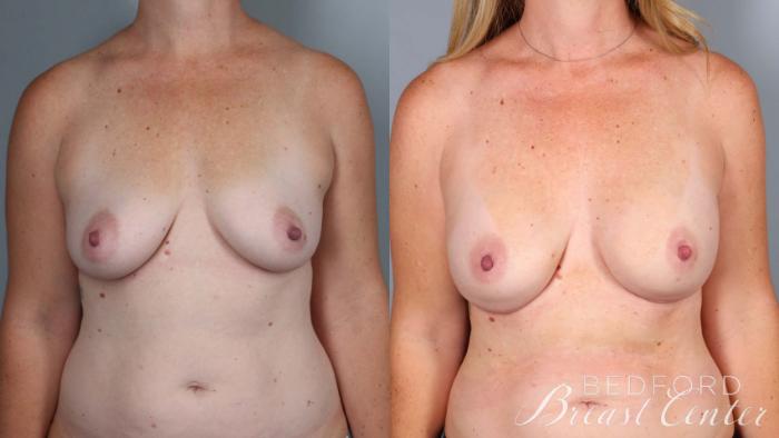 Before & After Nipple Sparing Mastectomy with One-Stage Breast Reconstruction Case 38 Front View in Beverly Hills, Los Angeles, Santa Monica, Glendale, and Malibu, CA