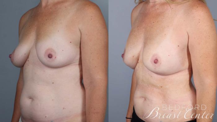 Before & After Nipple Sparing Mastectomy with One-Stage Breast Reconstruction Case 38 Left Oblique View in Beverly Hills, Los Angeles, Santa Monica, Glendale, and Malibu, CA